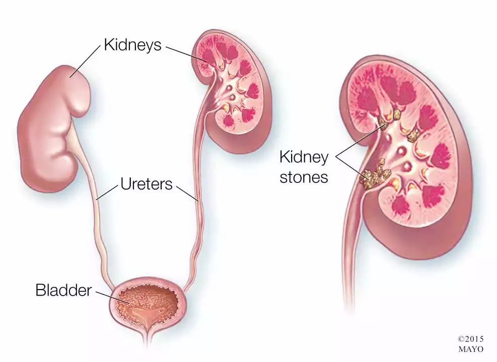 The Importance of Calcitriol in Preventing and Treating Kidney Stones